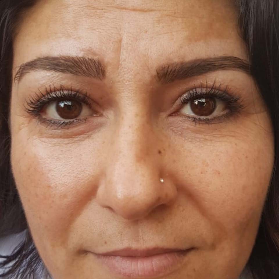 Microneedling - Before